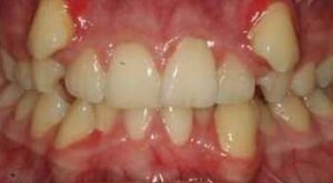 Permanent teeth that are growing into the wrong spots