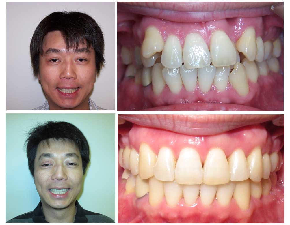 fixing crowding with Invisalign