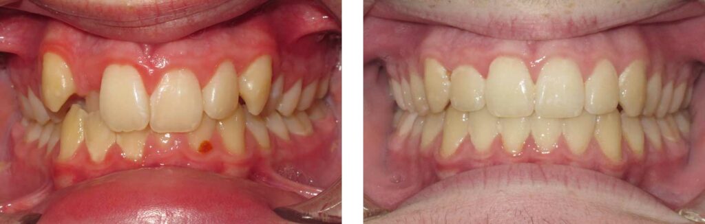 fixing a crossbite with invisalign