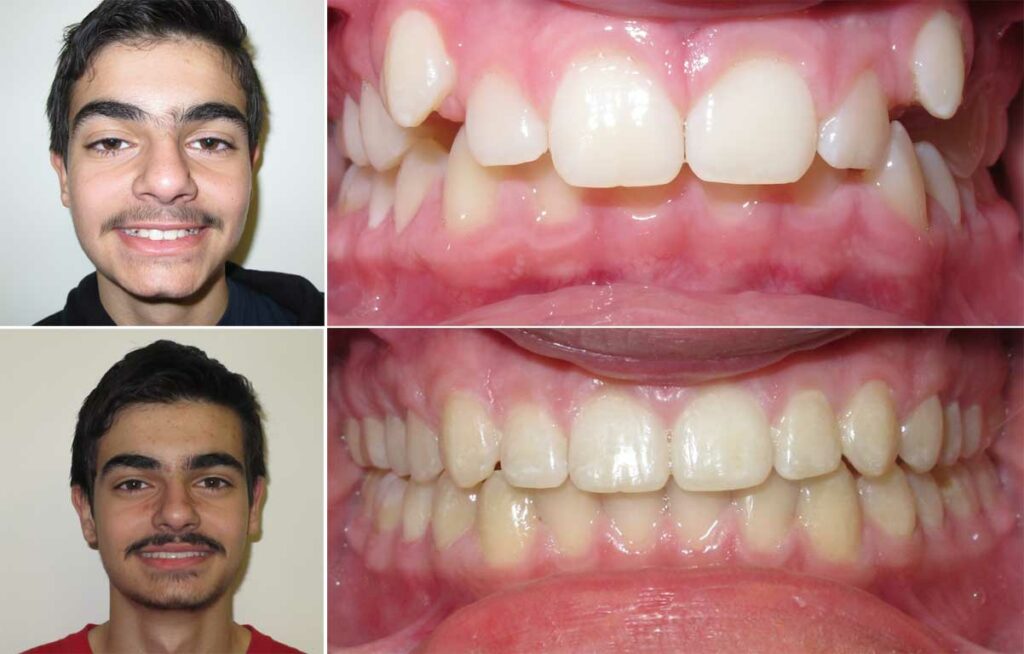 fixing a deep bite with Invisalign