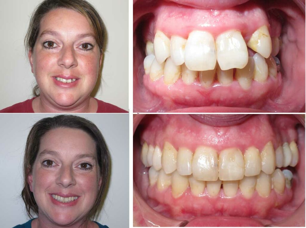 a real patient of Premier Orthodontics