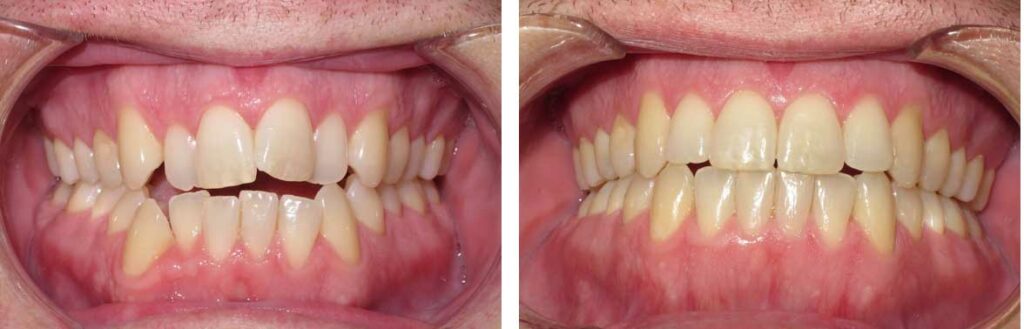 fixing an overbite with Invisalign