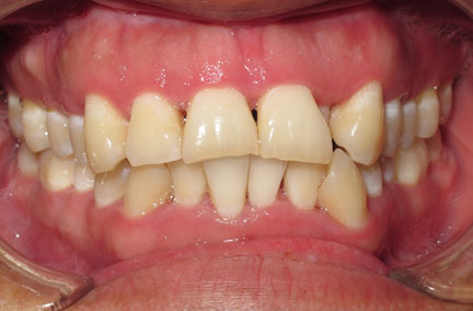 worn and chipped teeth due to a bite