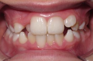 Mild Anterior Crossbite in an 8-Year Old Before Braces