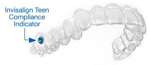 compliance indicator on Invisalign for teens