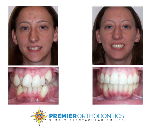 Premier Orthodontics - Fixed crowding teeth treated with metal braces
