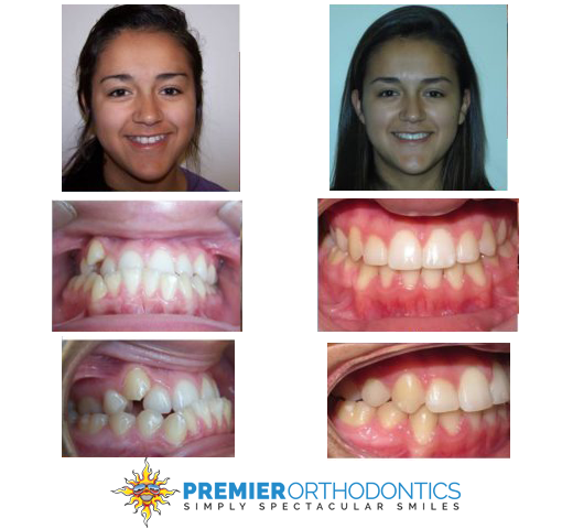 Actual patient of Premier Orthodontics