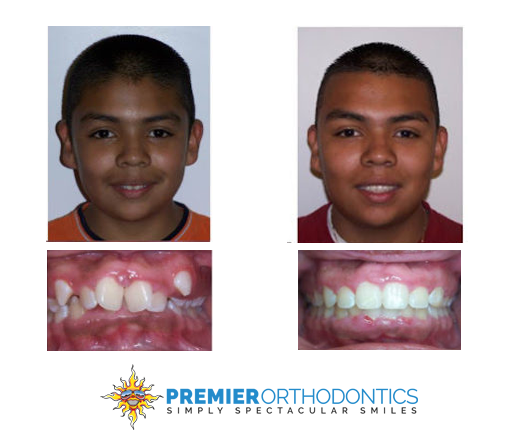 Patient at Premier Orthodontics