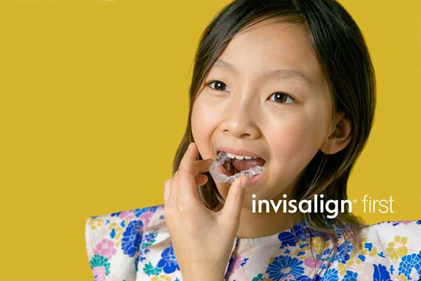 Invisalign First for Kids