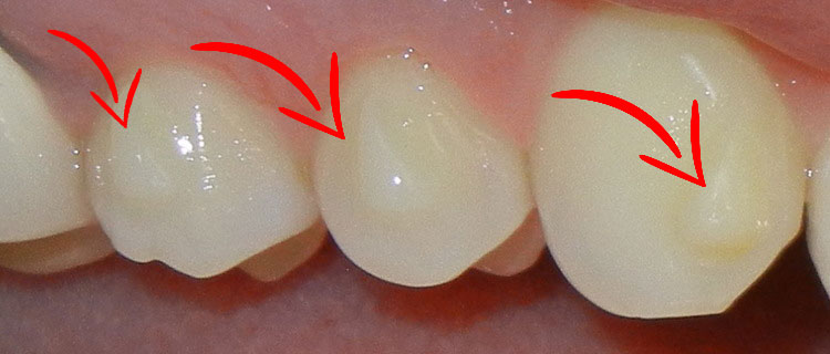 tooth attachments