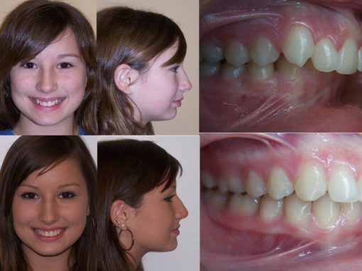 Actual Patient of Premier Orthodontics Treated With a Functional Appliance