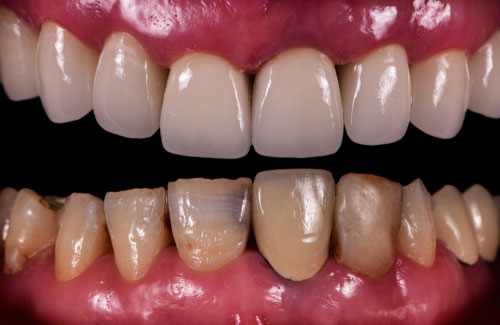 Veneers are a great option for correcting cosmetic dental problems