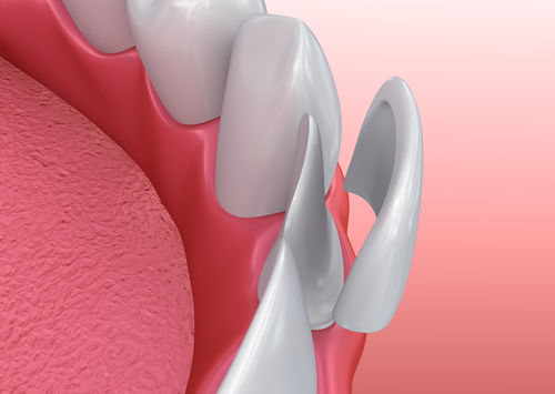 Porcelain veneers are meant solely for cosmetic purposes
