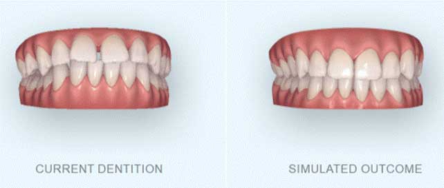 visualize your Invisalign results