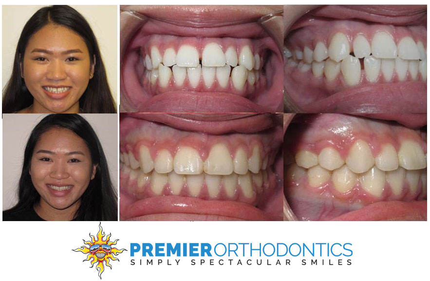 a real patient of premier orthodontics