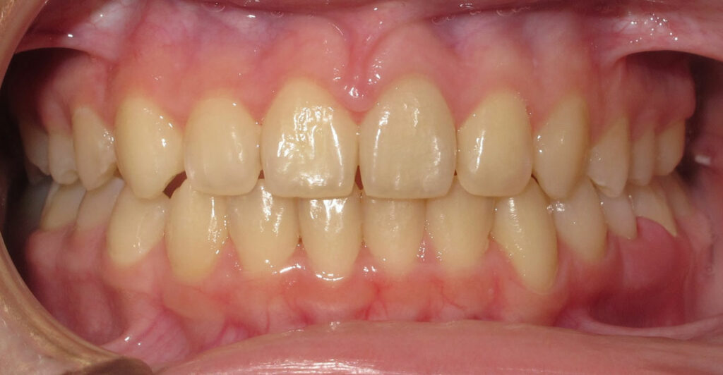 after treatment at premier orthodontics
