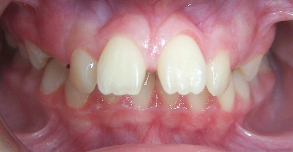 teen patient at premier orthodontics