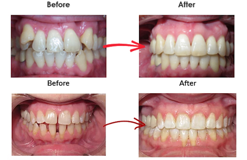 Premier Orthodontics patient treated with Invisalign
