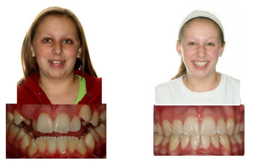 Patients treated with clear braces
