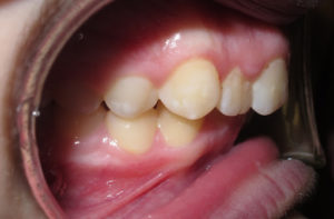 actual patient of Premier Orthodontics